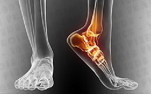 Votre pied souffre? Mal au talon? Venez faire un bilan du pied à la clinique 1001pieds ™ val-morin