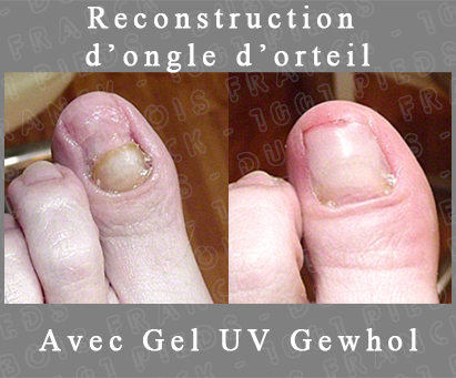 Reconstruction d'ongle d'orteil avec Gel-UV Gewhol